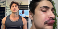 Influencer Ken de CG precisou ser internado ap&oacute;s espremer uma espinha Foto: Reprodu&ccedil;&atilde;o/Instagram/kendecg