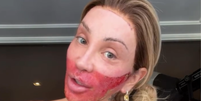 Maya Massafera aparece com o rosto queimado  Foto: Reprodução/Instagram