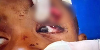Menino de 6 anos atingido em tiroteio no RJ perde a vis&atilde;o do olho esquerdo  Foto: Reprodu&ccedil;&atilde;o/ TV Globo 