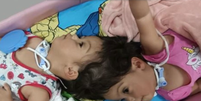 Morrem as gêmeas Helena e Heloísa, que nasceram unidas pela cabeça Foto: Reprodução/EPTV