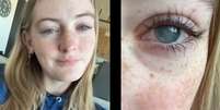 Jovem de 19 anos perde a vis&atilde;o ap&oacute;s infec&ccedil;&atilde;o rara ligada ao uso de lentes de contato Foto: Reprodu&ccedil;&atilde;o/Instagram