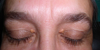Manchas e protuberâncias amareladas nos olhos são chamadas de xantelasma  Foto: Wikimedia
