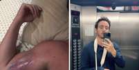 Wagner mostra hematoma após acidente em academia; ator mostra inchaço após tomar medicamento  Foto: Reprodução Instagram | @wagsantisteban