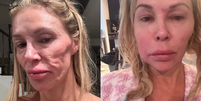 Brandi Glanville ficou com o rosto deformado por conta de suposto parasita Foto: Reprodu&ccedil;&atilde;o/Instagram