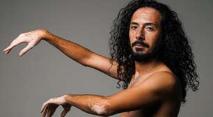 Entre 'curas milagrosas' e água de parto: modelo explica como é viver com vitiligo