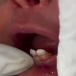 Bebê nasce com dentes e passa por cirurgia de extração aos seis dias de vida