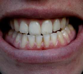 Featured image of post Dente Encavalado Embaixo dente q est encavalado mas todo m s ela n o faz nada al m de trocar de ferrinho n o sei o nome certo at hj n o mudou nada nos meus dentes superiores eu sei que um processo