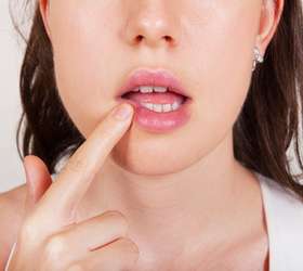 Causas herpes labial estres
