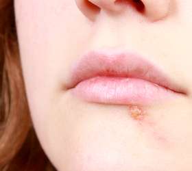 Causas herpes labial estres