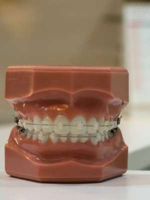 Aparelho na infância evita harmonização em adultos; saiba