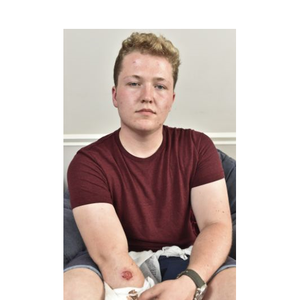 Adolescente é queimado por iPhone 5 enquanto dorme