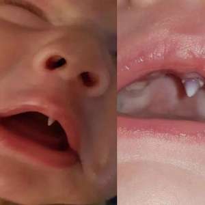 Criança nasce com dente de vampiro e assusta a família