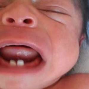 Bebê nasce com dentes e faz extração 10 dias após parto