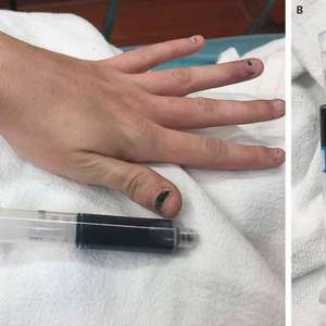 Remédio para dor de dente deixa mulher azul