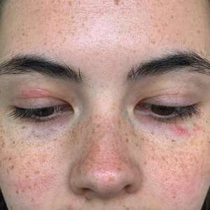 Jovem tem alergia a água e não pode tomar banho, chorar ...