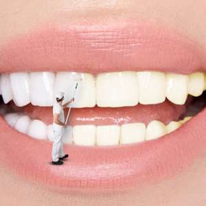 Esclareça 8 dúvidas sobre clareamento dental