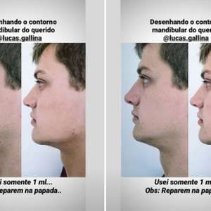 Ex-confinado do BBB mostra resultado de preenchimento labial