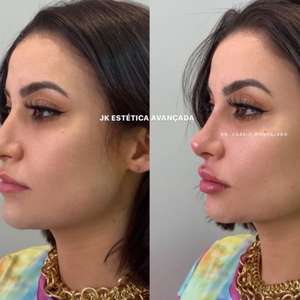 Bianca Andrade aumenta a boca e faz rinomodelação: ...