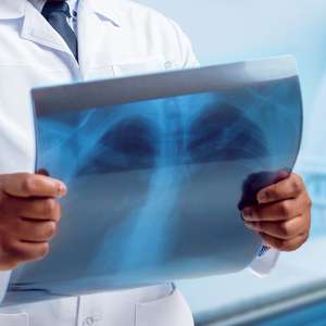 Covid-19: exame pioneiro mostra danos em pulmões 3 meses depois de infecção por coronavírus