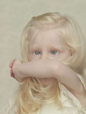 Você Sabia? Afrodescentes e indígenas podem ter albinismo?