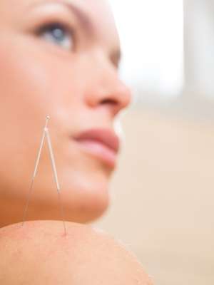 Técnicas de acupuntura tratam celulite, acne e até flacidez