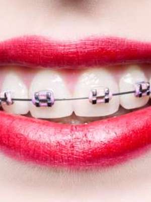 Quer alinhar o dente? Conheça os aparelhos e suas vantagens