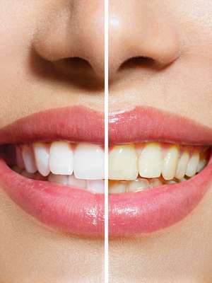 Sete alimentos que escurecem os dentes