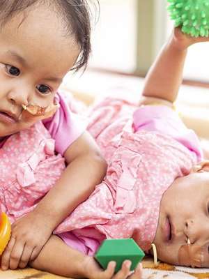 A bem-sucedida cirurgia de separação de gêmeas siamesas ...