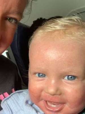 Mulher é expulsa de voo com bebê por ter doença de pele