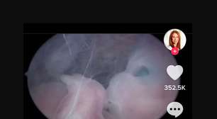 Vídeo impressionante mostra feto de 10 semanas em gravidez ectópica