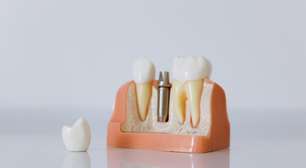 Implante dentário é caro? Saiba mais sobre a técnica que devolve o sorriso
