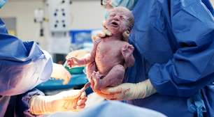 Corte de cordão umbilical logo após nascimento aumenta risco de anemia