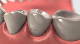 Confira mais informações sobre coroas dentárias