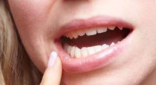 Heridas en la boca por más de una semana pueden ser VPH