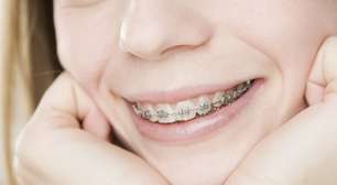 Conozca 8 mitos y verdades sobre los aparatos dentales