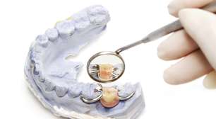 ¿Qué Son los Implantes Dentales?