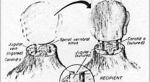 Transplante de cabeça pode ser realidade em breve,diz médico
