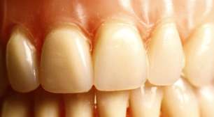 Las causas de dientes amarillos que no se puede evitar