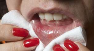 Feridas na boca cicatrizam 5 vezes mais rápido que no corpo