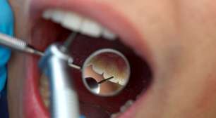 Mito ou verdade: tratamento de canal escurece o dente?