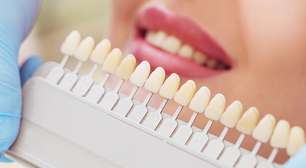 Facetas de porcelana ou lente de contato dental, qual escolher?