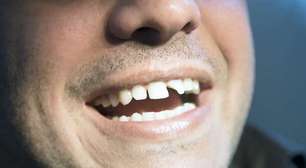 Dossiê dente quebrado: descubra o que fazer e como cuidar