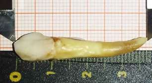 Dentista alemão extrai o maior dente da história