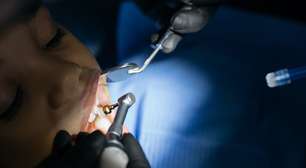 Como evitar o tártaro em dentes com aparelho