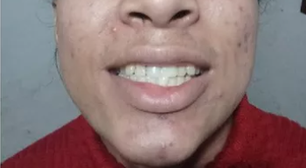 Mulher trans que teve dente quebrado por homem recupera sorriso
