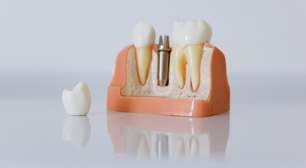 Implante dentário é caro? Saiba mais sobre a técnica que devolve o sorriso