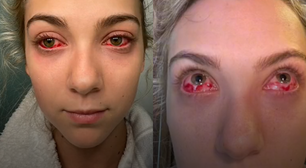 Jovem tem reação alérgica após fazer extensão de cílios e fica com 'olhos de zumbi'