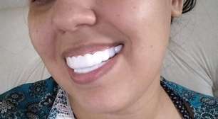 Mulher espera quatro meses por 'lentes dentais' e viraliza; veja resultado