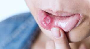 Aftas na boca e na língua: causas e tratamento