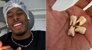 Ex-BBB Paulo André extrai os 4 sisos e tamanho dos dentes surpreende